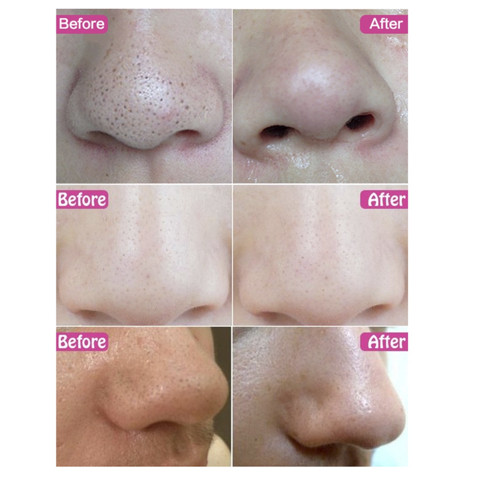 Set 5 Miếng Dán Mũi Lột Mụn Đầu Đen Sace Lady
