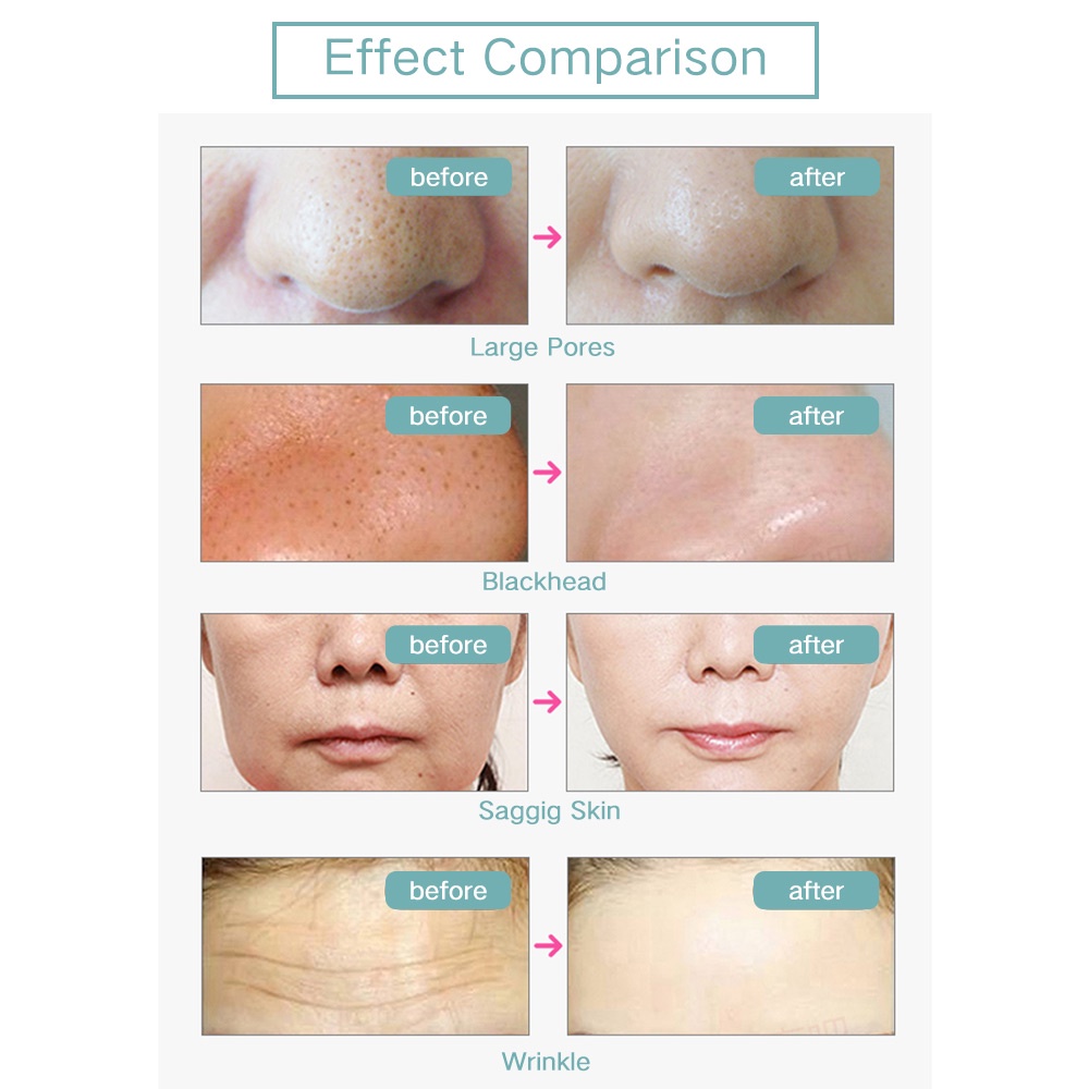 Kem Gel EMS Dưỡng Ẩm Nâng Cơ Mặt Chống Lão Hóa Và Nếp Nhăn