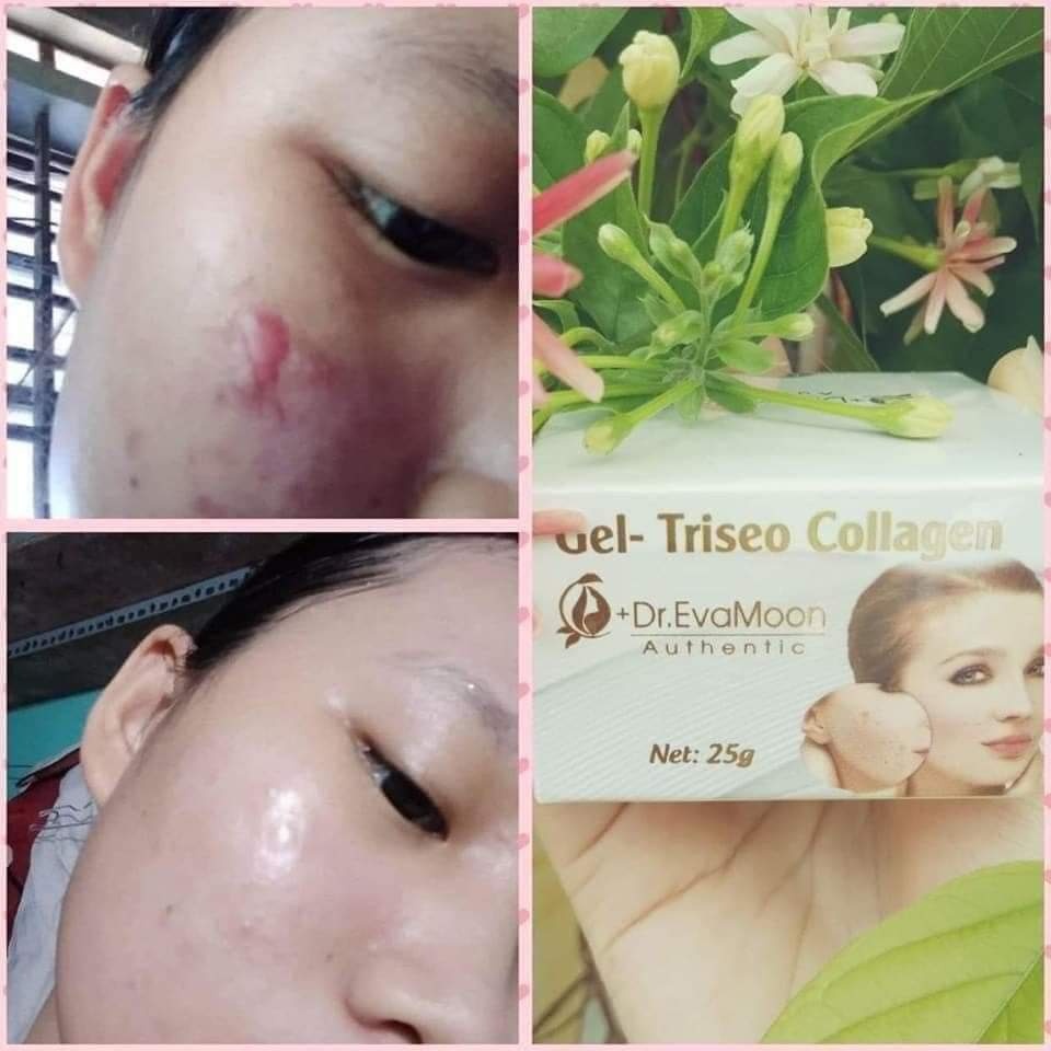 Kem mờ sẹo Gentacin, làm mờ sẹo lồi, sẹo rỗ, sẹo thâm EVA
