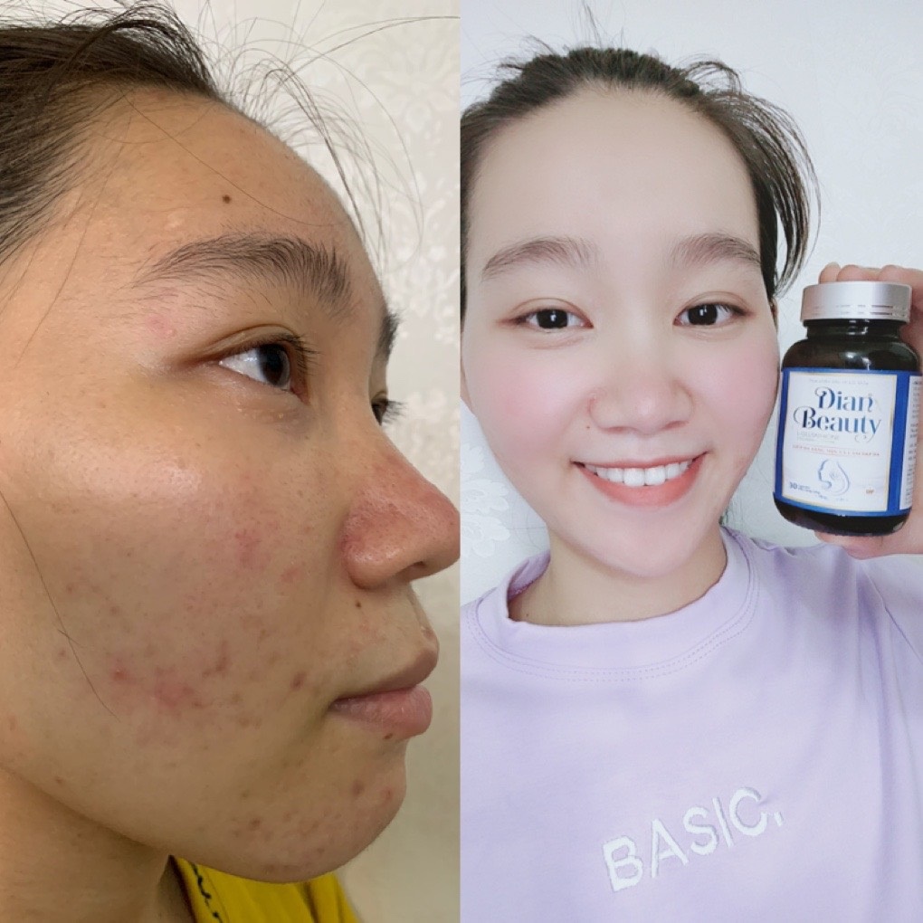 Viên Uống Trắng Da Dian Beauty, [Mua 1 Tặng 2] ,Mua 2 Giảm thêm 59K, FreeShip, Trắng toàn thân, mờ nám | Thế Giới Skin Care
