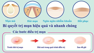 MIẾNG DÁN MỤN MAYAN CARE ULTRA THIS SPOT ACNE PATCH (Hộp 20+4 miếng)