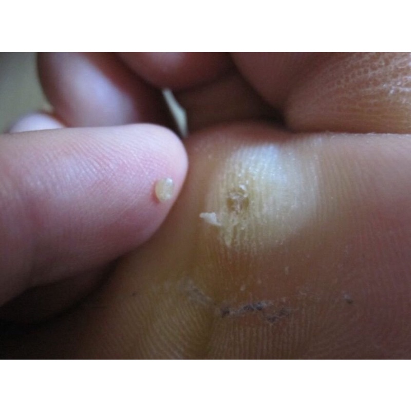 Miếng dán mụn cóc IBOKORORI 12 miếng (Nhật Bản) | BigBuy360 - bigbuy360.vn