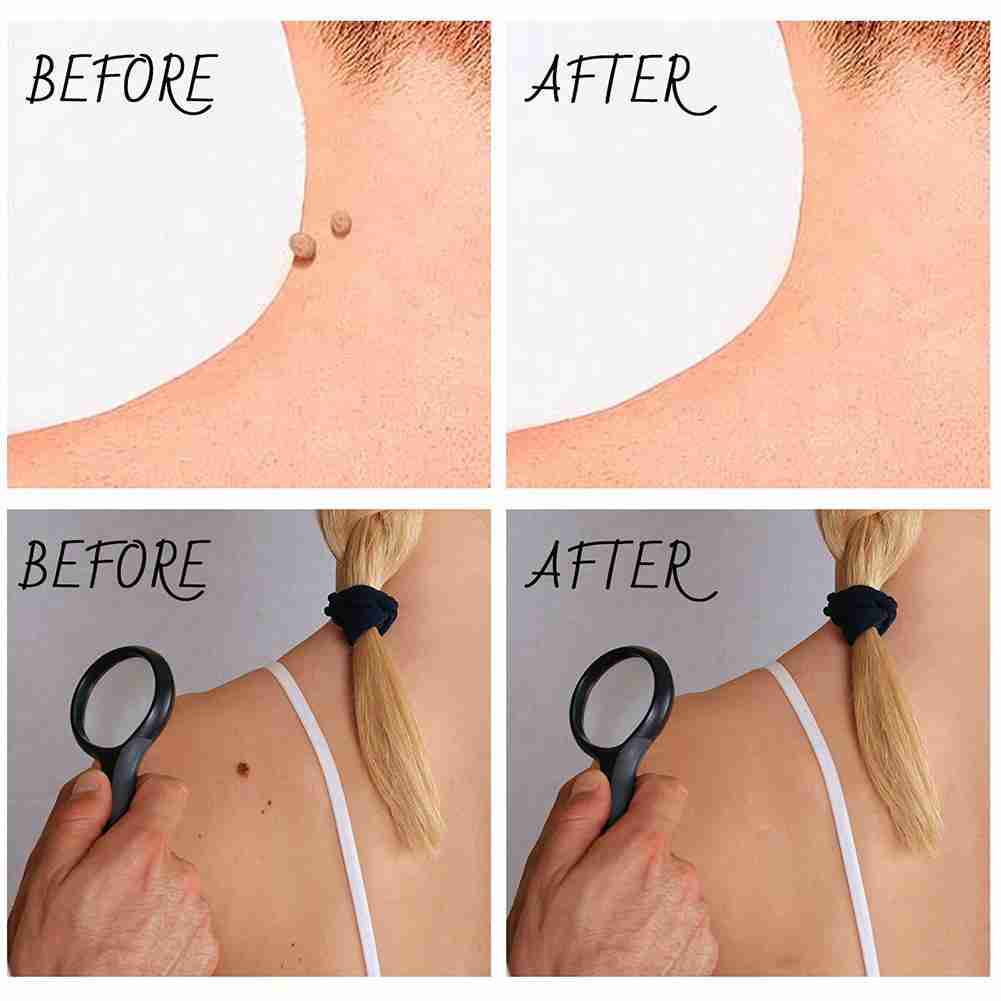 [Hàng mới về] Dung dịch loại bỏ mụn cóc / nốt ruồi A8T2