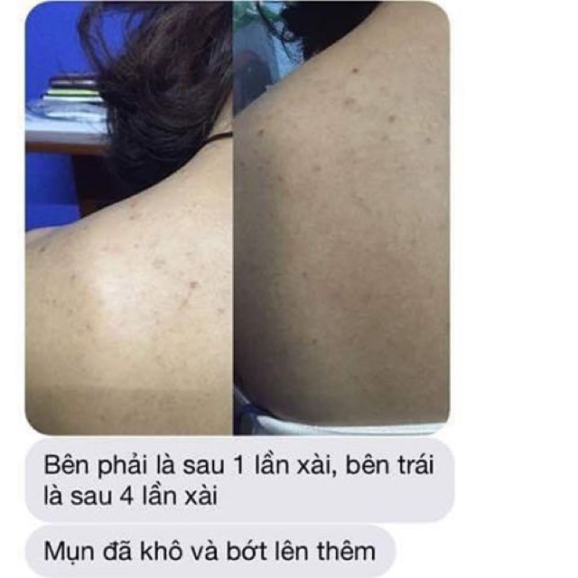 XÀ PHÒNG GIẢM MỤN LƯNG FOR BACK NHẬT BẢN