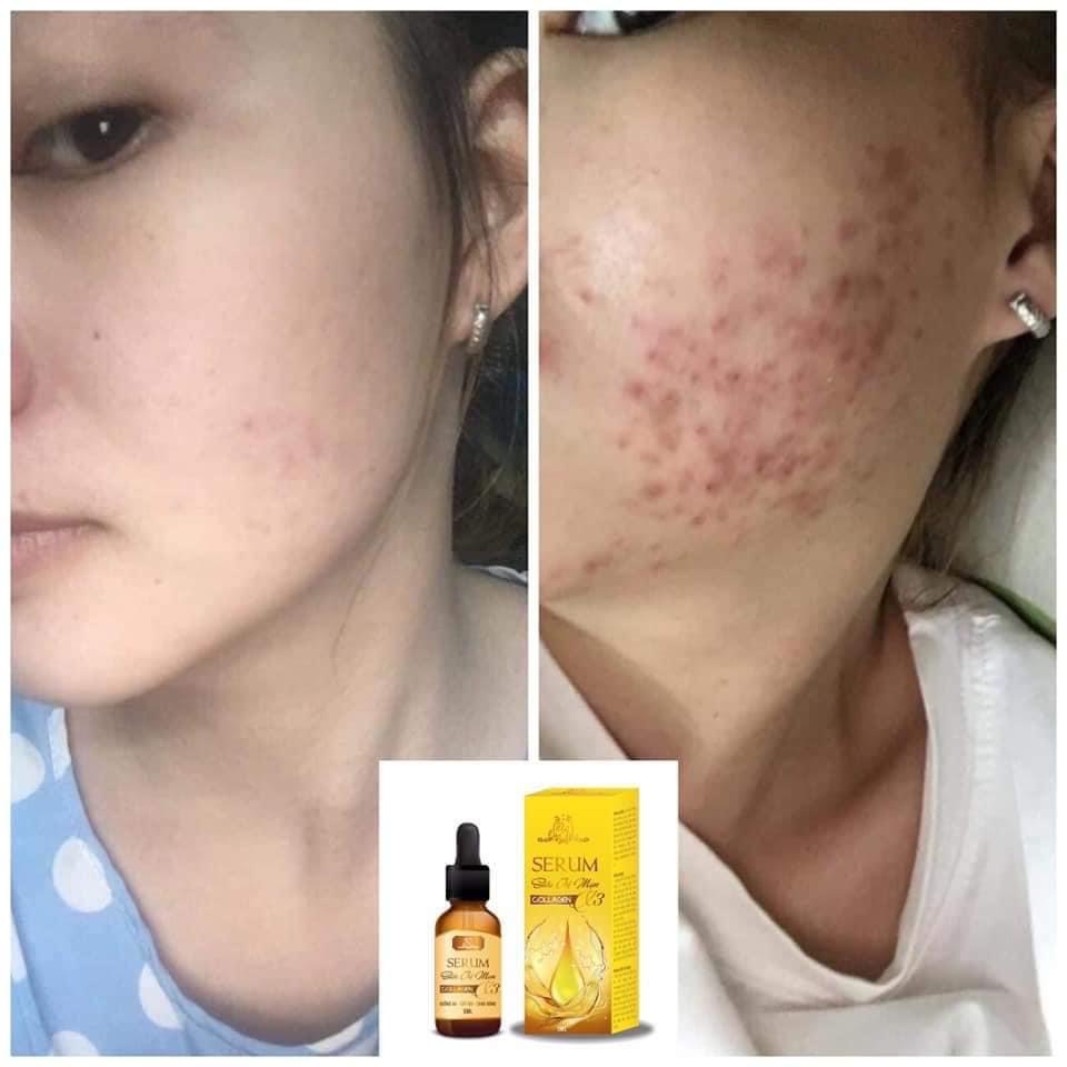 Serum mụn Collagen X3 Luxury mỹ phẩm Đông Anh