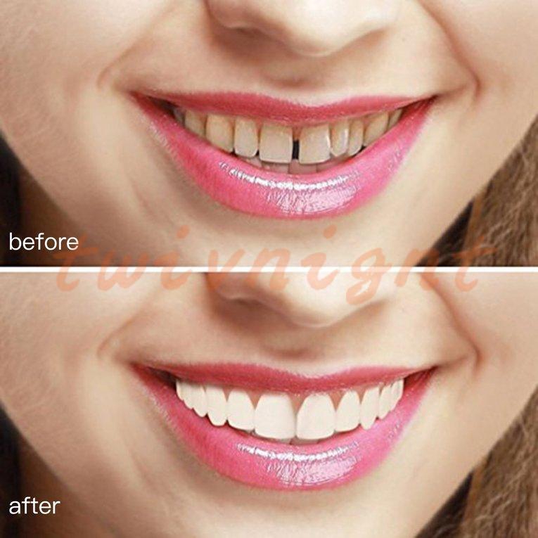 Răng giả dán hàm trên làm trắng vừa vặn thoải mái tạo nụ cười hoàn hảo nhanh chóng