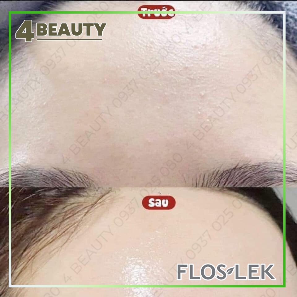 Kem Dưỡng Ẩm Và Kiểm Soát Dầu Floslek Anti Acne Mattifying Cream