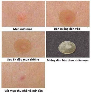 Miếng Dán Mụn Mayancare Ultra Thin Sport