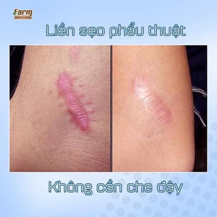 Kem KLIRVIN Chuyên Gia Làm Mờ Sẹo 25G của Nga