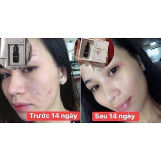 Huyết thanh mụn hiệu quả 24h