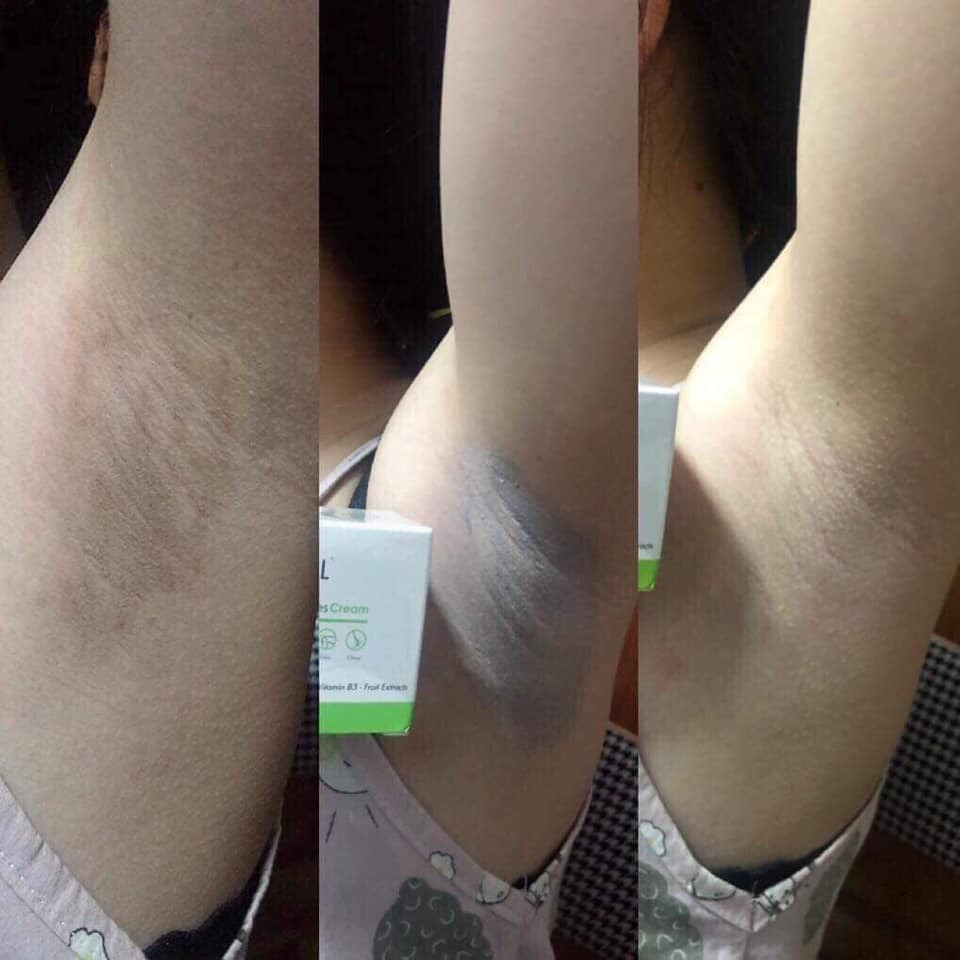 Kem Xóa Vết Thâm OL-CELL