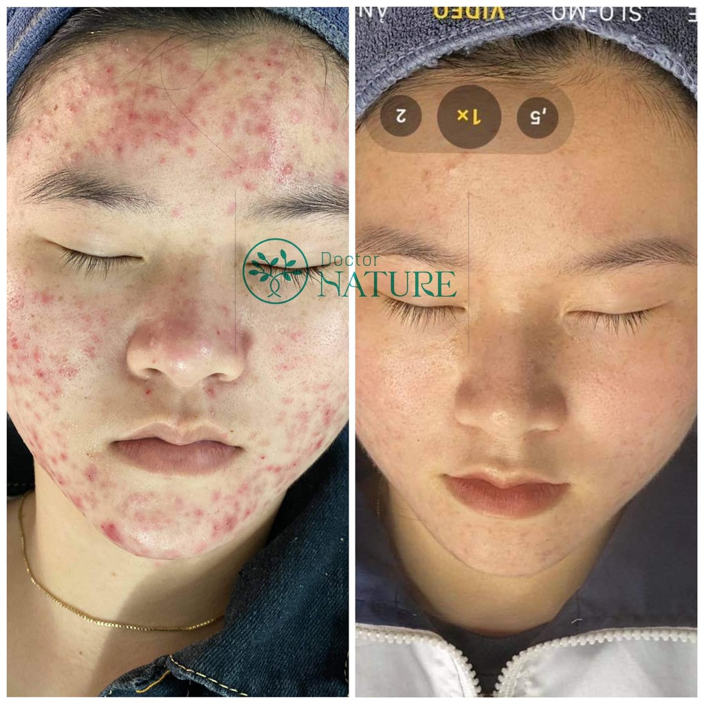 SERUM MỤN ACNES DR.NATURE-