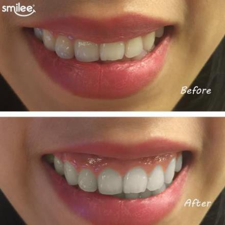 [Khuôn dẻo Smilee] Khuôn dẻo làm trắng răng Smilee - trong bộ Smilee - Tẩy trắng răng tại nhà