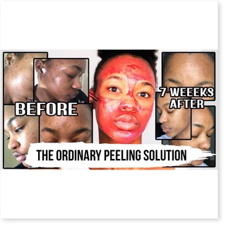 Serum The Ordinary AHA 30% và BHA 2% Peeling Solution