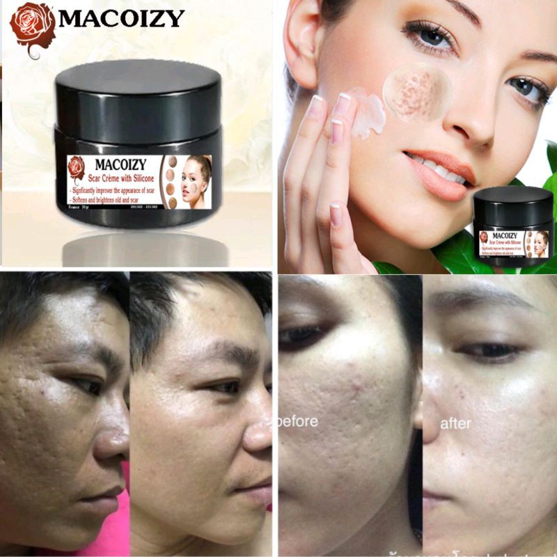 KEM SẸO RỖ SẸO MỤN SẸO THÂM TRẮNG DA