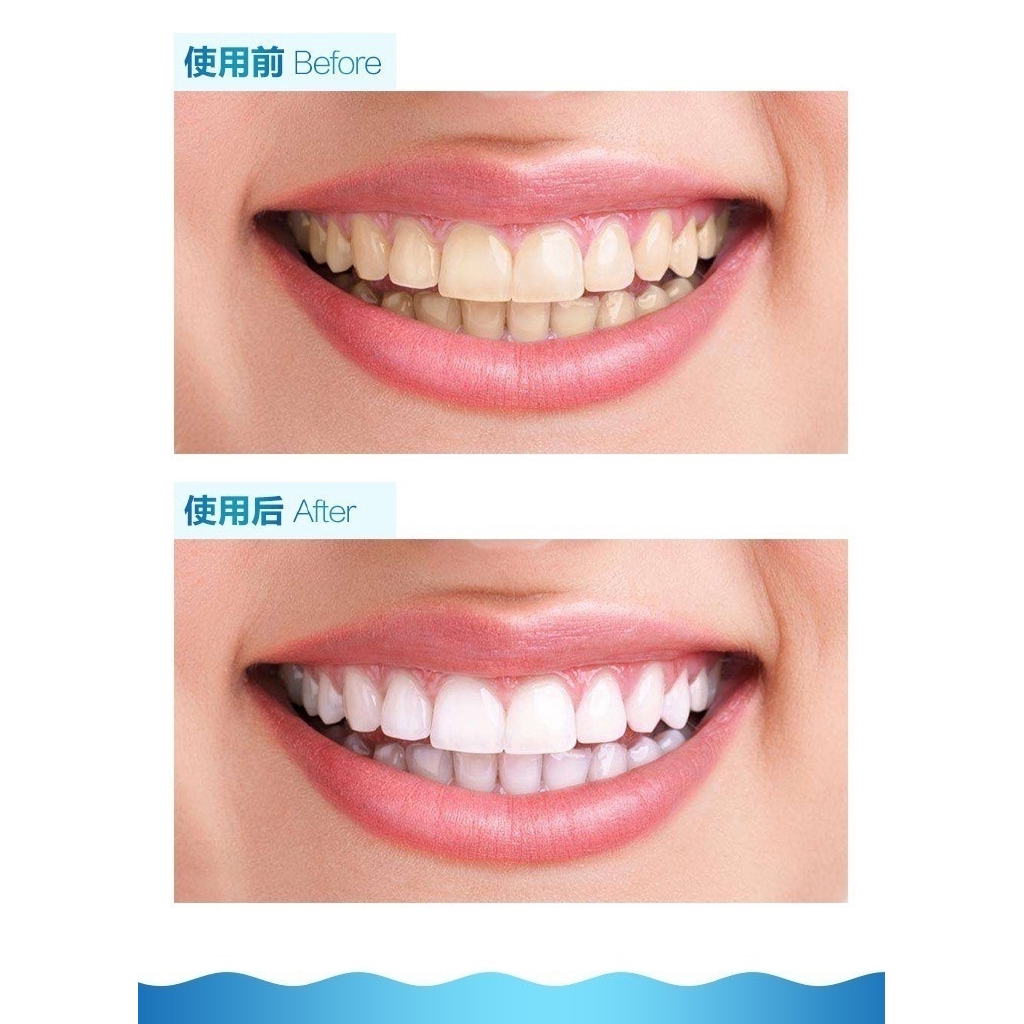Máy làm trắng răng thiết kế nhỏ gọn bằng ánh sáng xanh để sử dụng tại nhà