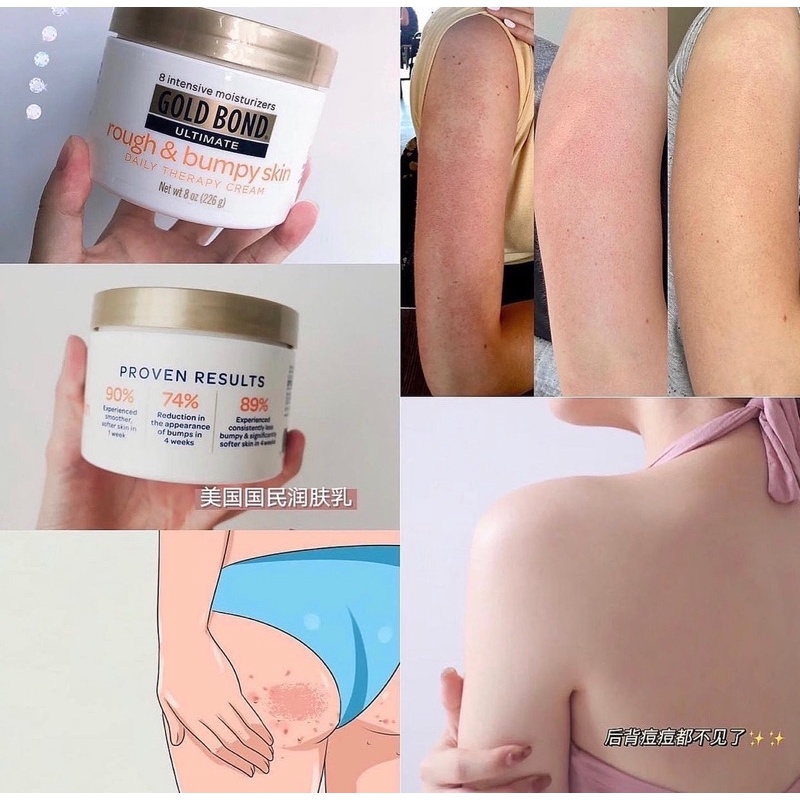 AUTH - OFF 40% LOTION KEM DƯỠNG DA MƯỚT MỊN TOÀN THÂN BODY GOLD BOND ULTIMATE ROUGE & BUMPY SKIN DAILY THERAPY CREAM