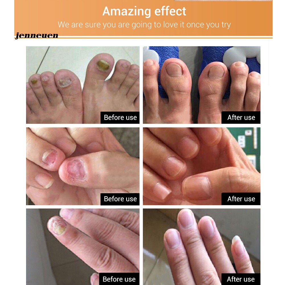 [Hàng mới về] Tinh chất phục hồi móng tay chống nấm 15ml | BigBuy360 - bigbuy360.vn