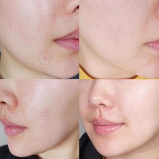 Miếng Dán Mụn Cosrx Acne Patch Các Loại