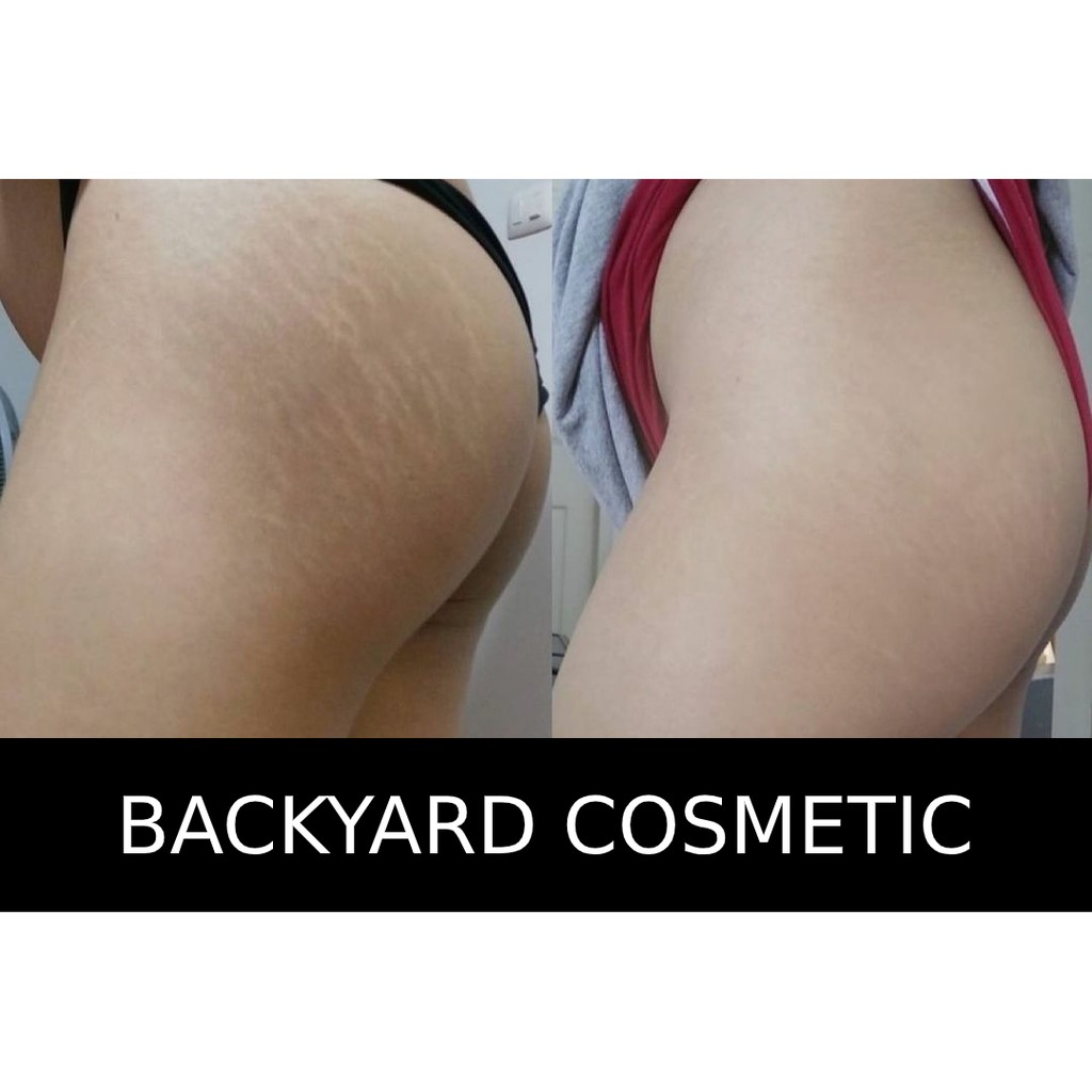 Tinh chất Serum Gíup Giảm Mụn, Mờ Thâm Mông, Trắng Da Và Hỗ Trợ Điều Trị Rạn- Backyard Cosmetic 10%Niacinamide - 30ml | BigBuy360 - bigbuy360.vn