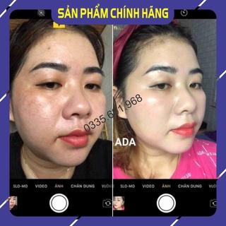 Bộ 5  Căng bóng- Trẻ hoá- ADA GROUP