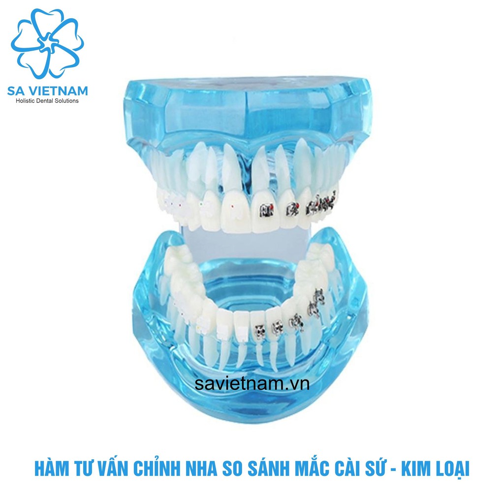 Mẫu hàm tư vấn so sánh chỉnh nha mắc cài kim loại và mắc cài sứ – mô hình nắn chỉnh răng nha khoa