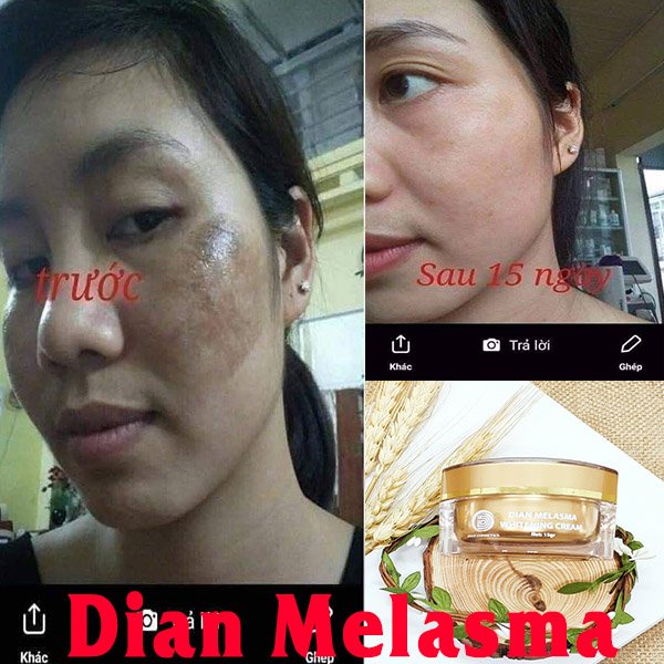 Kem mờ nám DIAN BEAUTY MELASMA, hỗ trợ làm đẹp da, dưỡng da mặt, mờ nám, thâm mụn