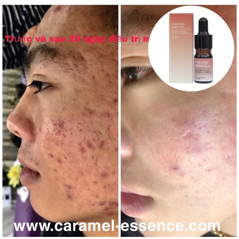 Combo 2Serum tang 1 Caramel Essence  ttrị mụn,kiểm soát bã nhờn, ngừa thâm sẹo Nhật Bản