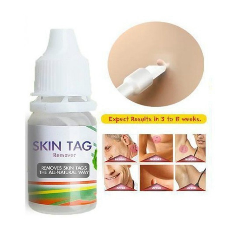 Skin Tag Remover 12 Hours Tu Kill Tu Kill Remover Skin Tag Mole & Genital Wart Remover Foot Corn Removal 10Ml