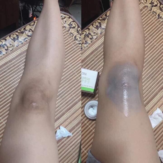 Kem mờ thâm OL-Cell Hàn Quốc. Luôn có sẵn số lượng lớn. chuyên sỉ cho đại lý và Spa