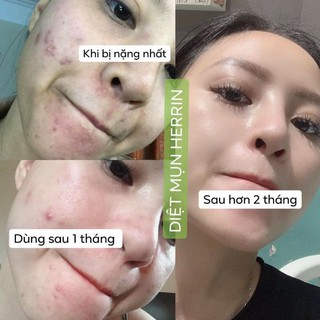 TINH CHẤT DIỆT MỤN 24H HERRIN CARE