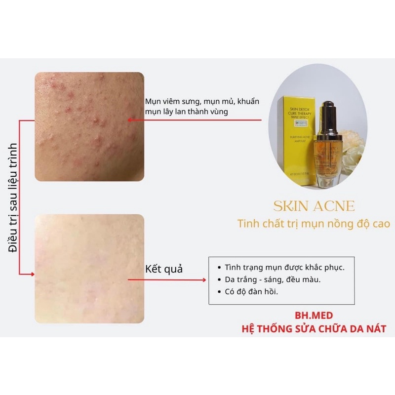 Tinh chất giảm mụn Skin detox Ettre Belle 30ml và tế bào gốc Skin Cell Etre Belle 30ml