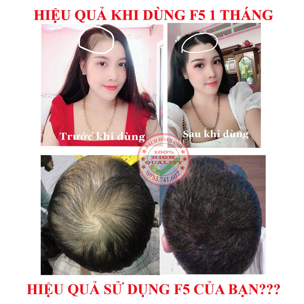 Dầu gội gội thảo dược ngăn rụng tóc F5, giảm rụng tóc, kích thích mọc tóc nhanh, an toàn, không gây kích ứng da đầu | BigBuy360 - bigbuy360.vn
