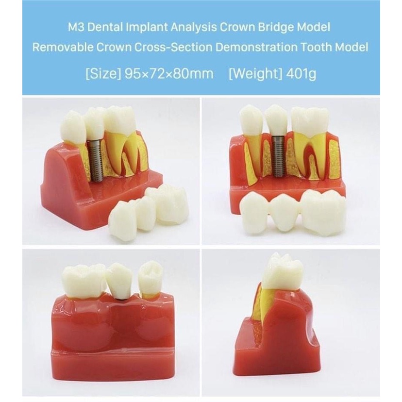 Mô hình tư vấn Implant, cầu 3 răng dùng trong Nha khoa