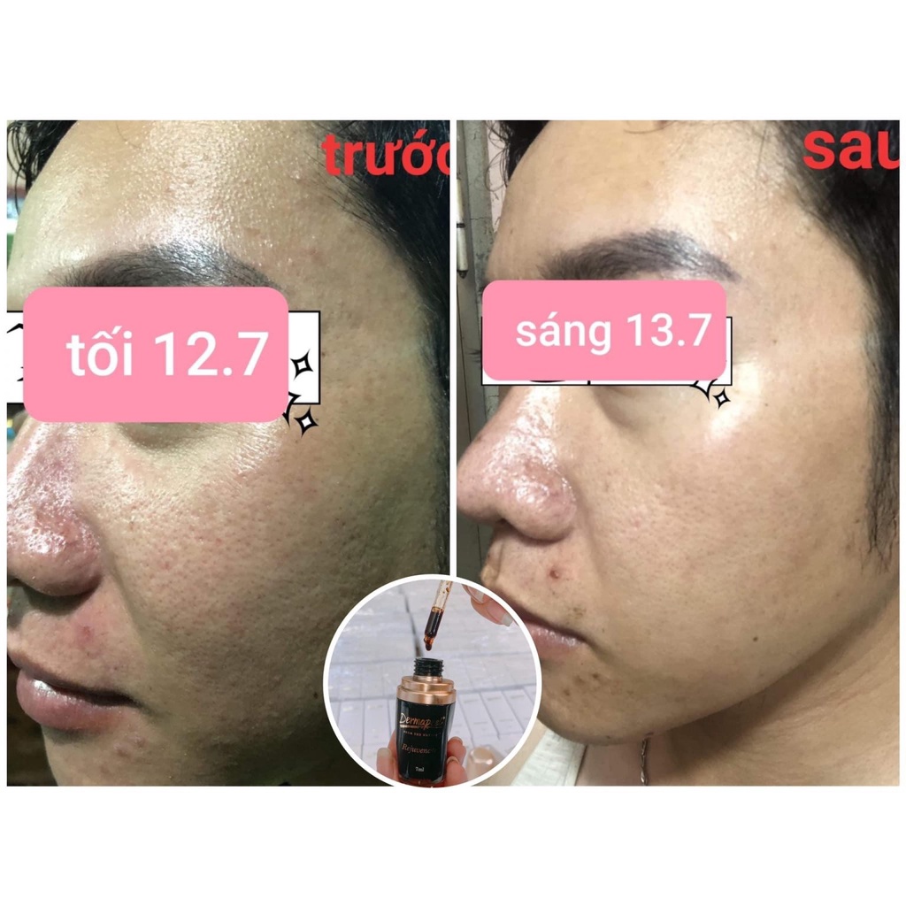 SERUM Dermapeel+ 7ml TRỨNG CÁ TUYẾT - XÓA MỤN - Mờ THÂM MỤN - Se Khít LCL - DA CĂNG BÓNG