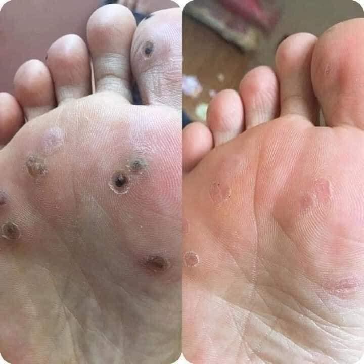 Dung dịch diệt mụn cơm, mụn cóc, sạn cá, mụn thịt của nga, sẵn hàng | BigBuy360 - bigbuy360.vn