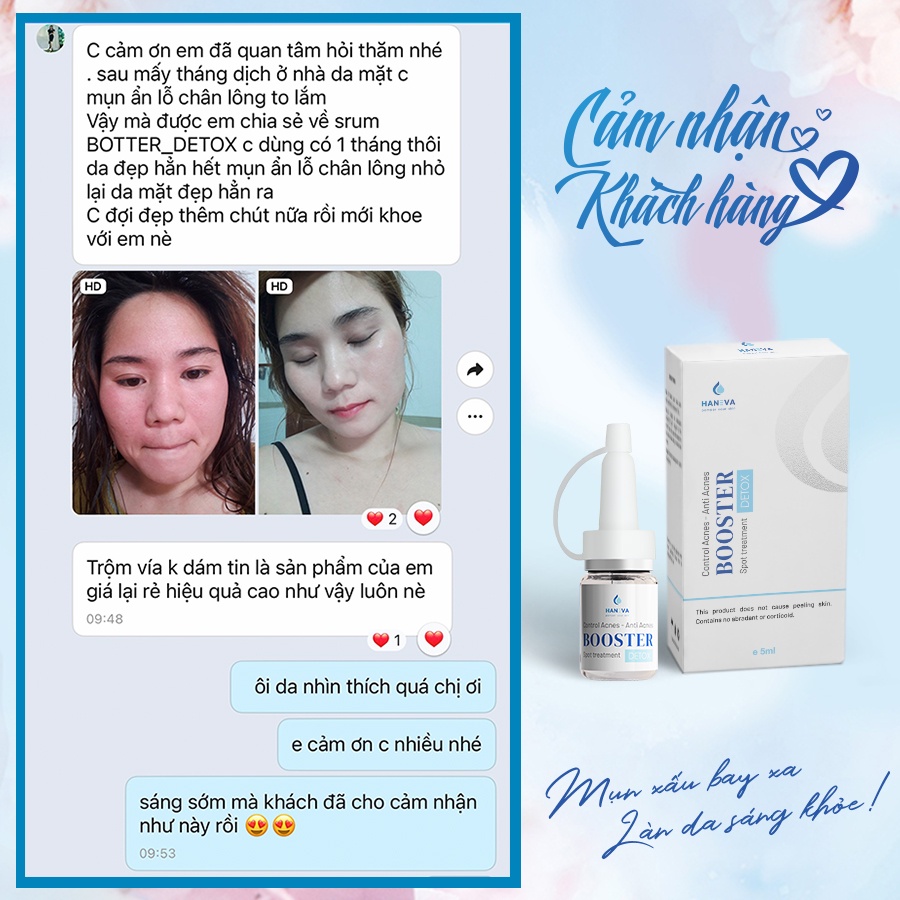 Serum giảm mụn HANEVA, tinh chất ngừa, đánh bay mụn, sạch thâm, dưỡng trắng da hiệu quả chỉ sau 7 ngày