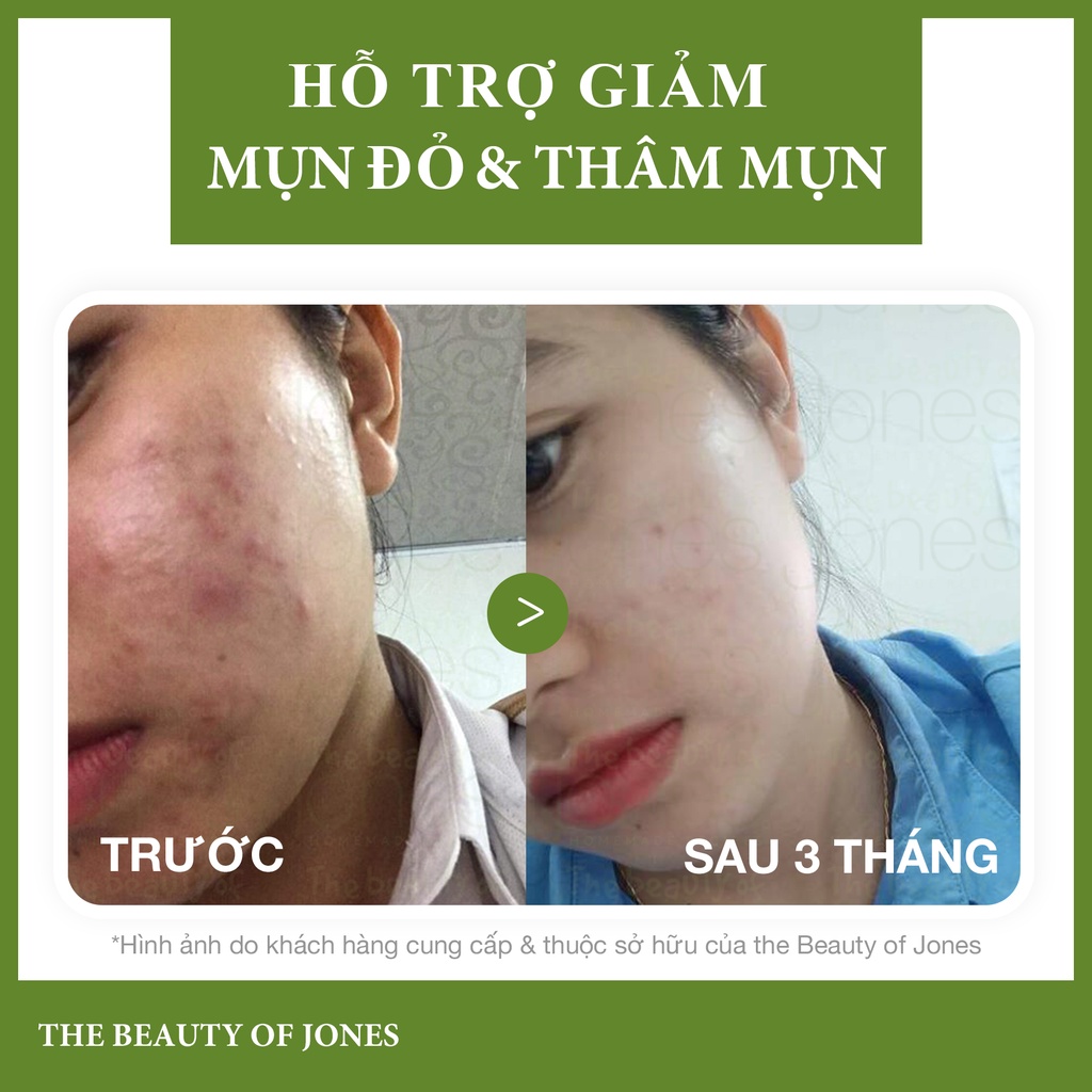 Kem mụn cho da nhạy cảm từ tràm trà The Beauty of Jones