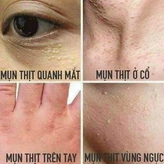 Mụn cóc , mắt cá , chai sần Nunamin