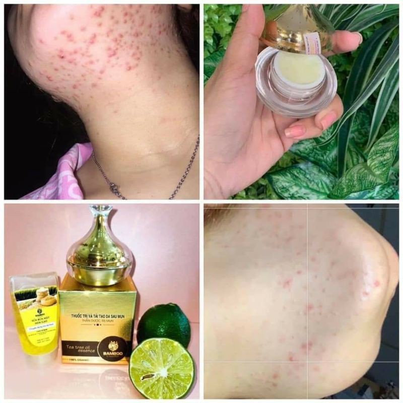 Kem Mụn Bamboo tặng sữa rửa mặt hoa gạo bamboo