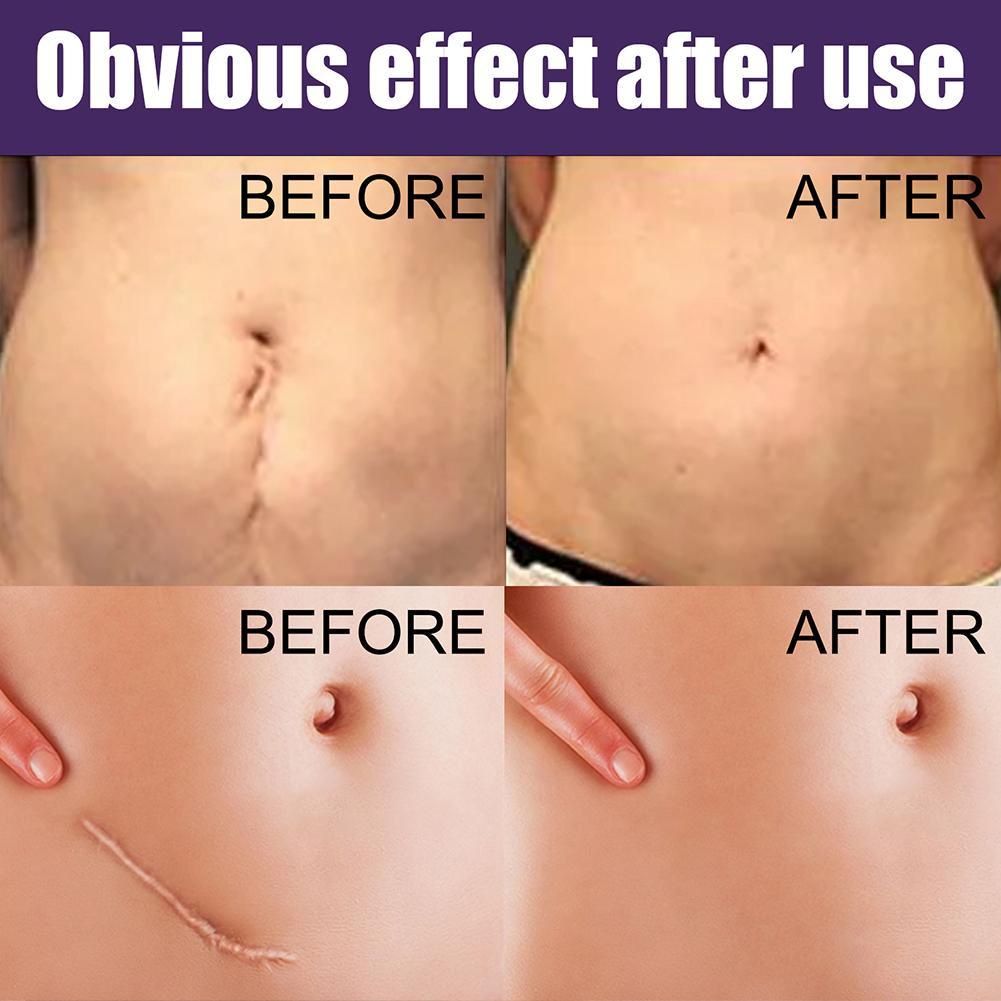 Bộ 8 Miếng Dán Silicone Hỗ trợ giảm sẹo Làm Sáng Tông Màu Da Q2T4