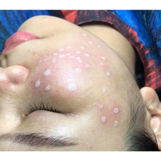 TCA 50% chấm tàn nhang, sẹo rỗ, nốt ruồi 2ml