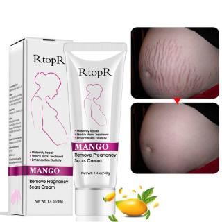 [Hàng mới về] Kem Xóa Vết Rạn Da Và Sẹo Cho Phụ Nữ Mang Thai Chất Lượng Cao