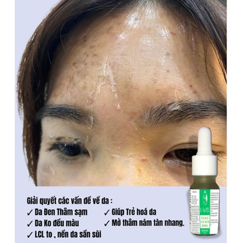 Peel Hút Nám Bong Da Vi Tảo Trắng Da Bezy Cao Cấp