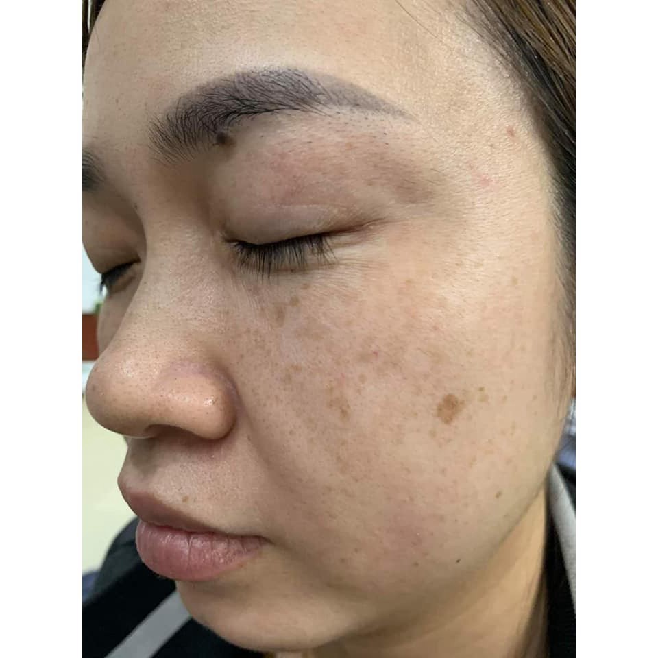 Cao Cấp Dịch Chiết Thảo Mộc Làm Sạch Nám - Tàn Nhang - Thâm Mụn Almonds 50ml .. | BigBuy360 - bigbuy360.vn