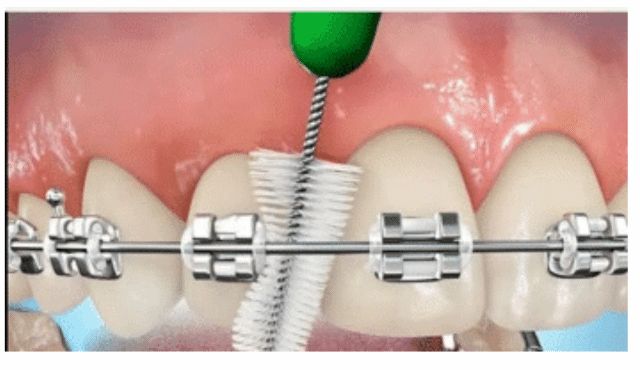 Bàn chải kẽ răng, đặc biệt rất cần thiết cho răng niềng, chỉnh nha