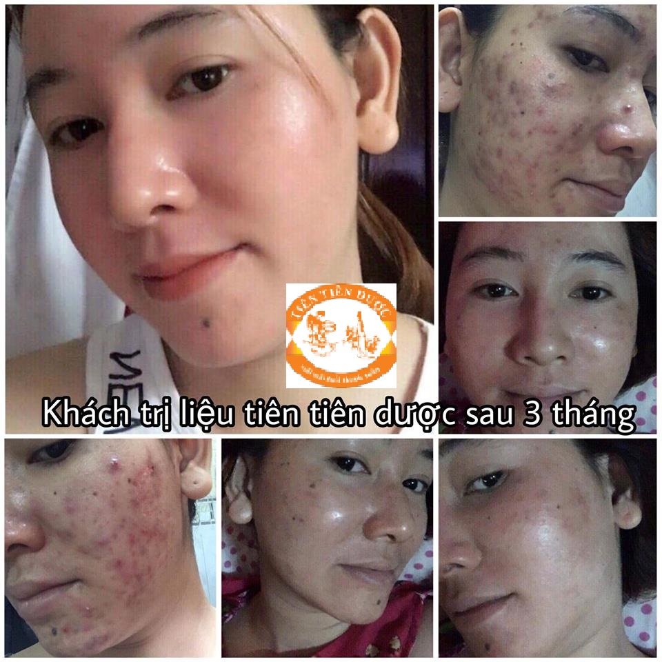 Combo tái tạo da Tiên Tiên Dược