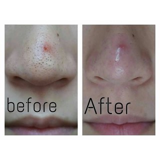 Lột mụn đầu đen Goodbye Blackhead Ciracle