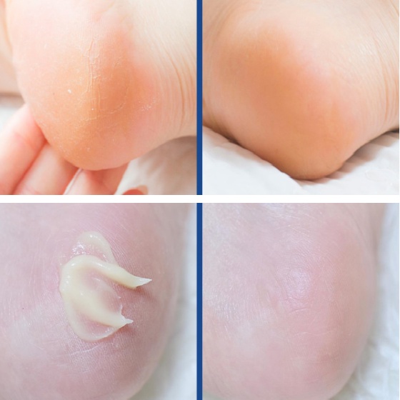 Kem dưỡng ẩm da bàn chân MEDI EGF loại bỏ nứt nẻ 130g