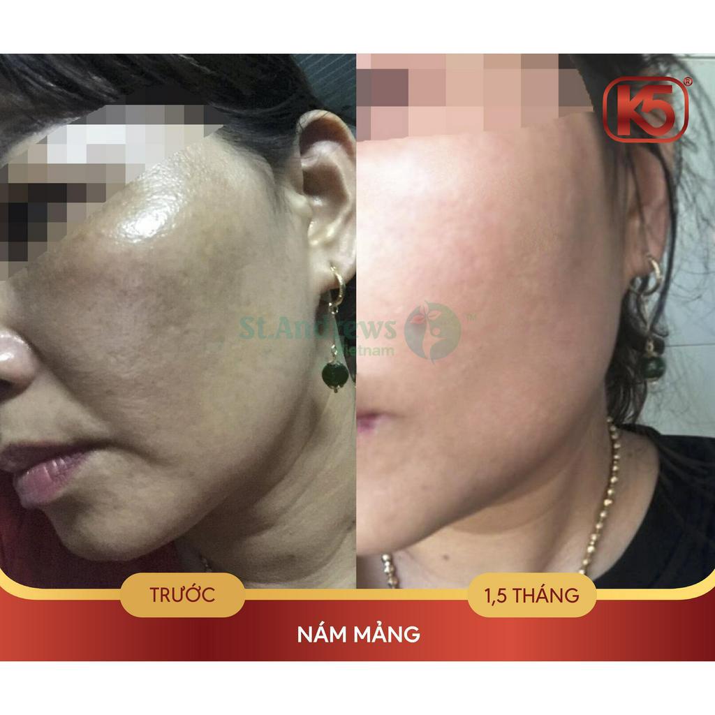 Kem chống tăng sắc tố sau lăn kim, phi kim tốt nhất hiện nay K5 Cryolaser 20ml